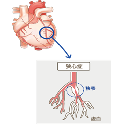 狭心症のイメージ図