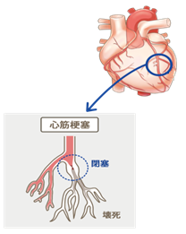 心筋梗塞のイメージ図